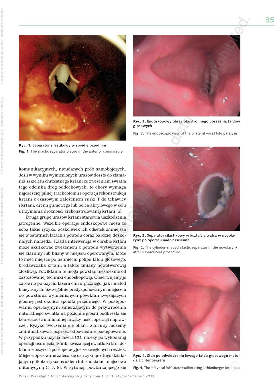 The cylinder-shaped silastic separator in the novolarynx after supracricoid procedure is c op y is for pe rs on al komunikacyjnych, nieudanych prób samobójczych.