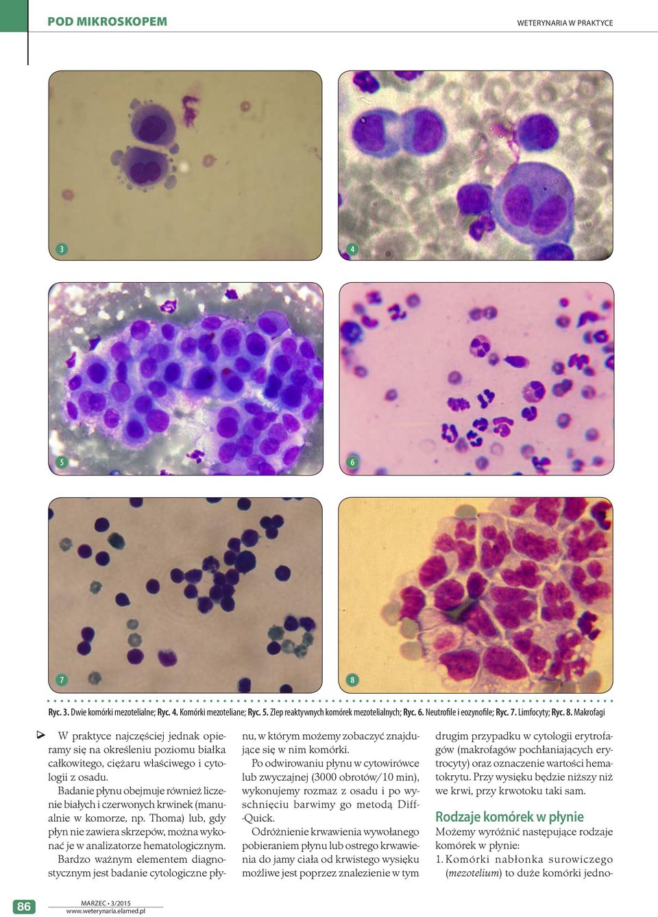 Bardzo ważnym elementem diagnostycznym jest badanie cytologiczne pły- Rodzaje komórek w płynie Możemy wyróżnić następujące rodzaje komórek w płynie: 1.