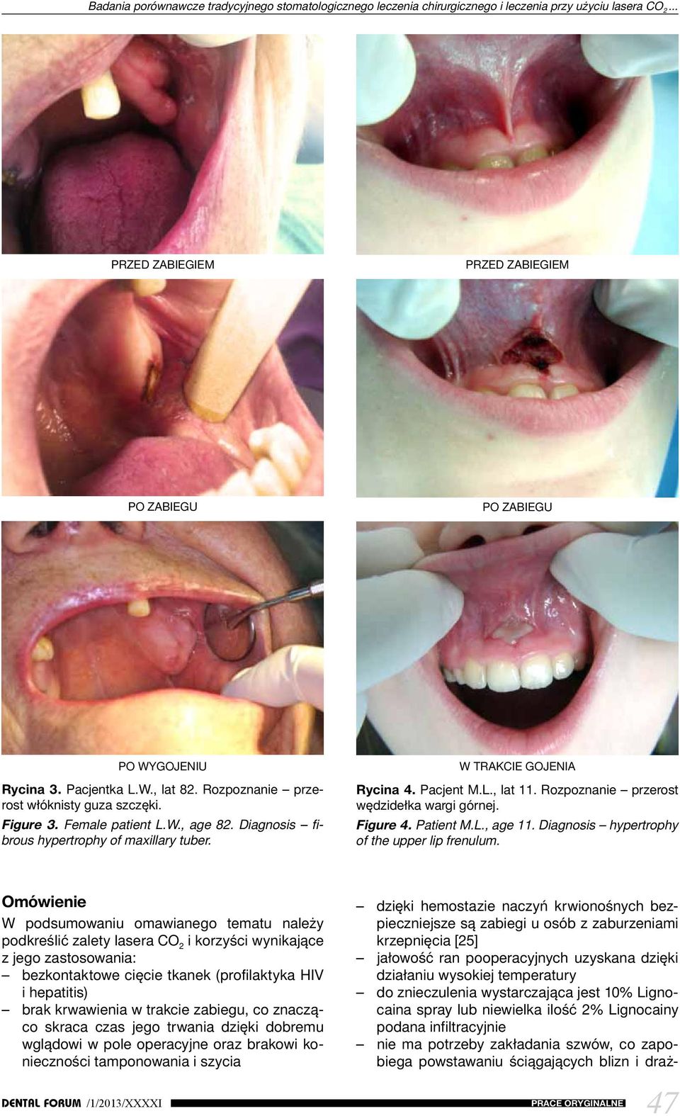 Rozpoznanie przerost wędzidełka wargi górnej. Figure 4. Patient M.L., age 11. Diagnosis hypertrophy of the upper lip frenulum.