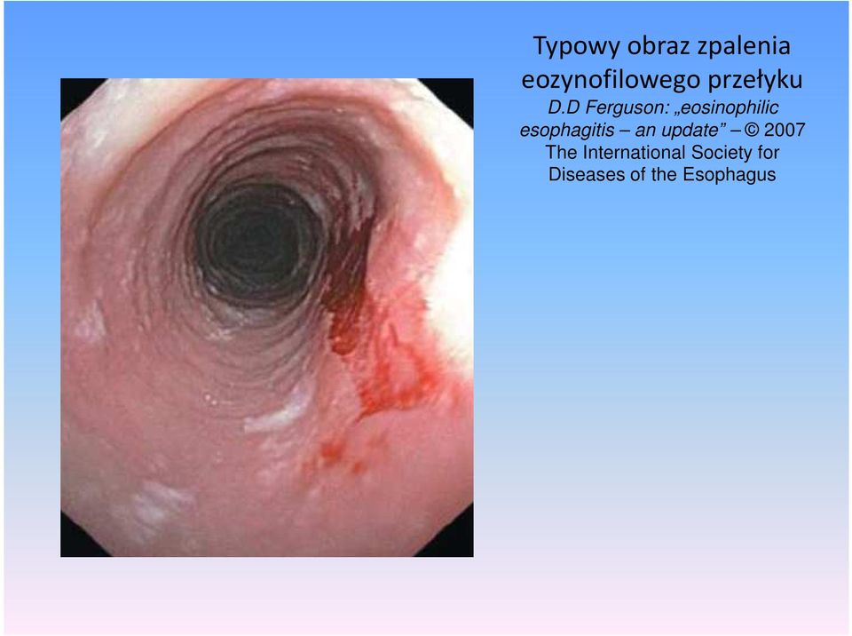 D Ferguson: eosinophilic esophagitis