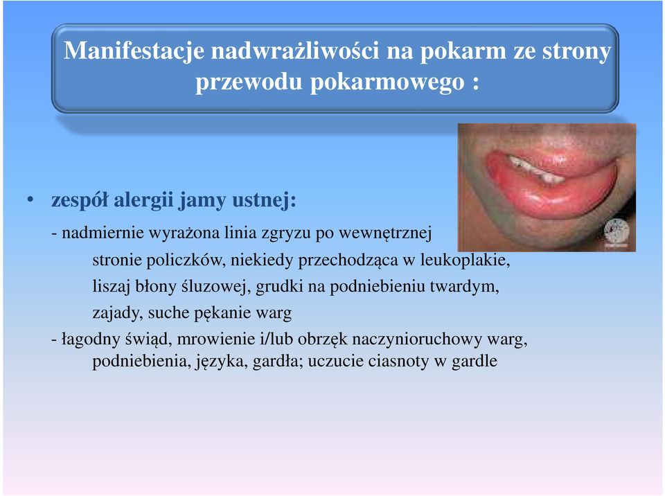 leukoplakie, liszaj błony śluzowej, grudki na podniebieniu twardym, zajady, suche pękanie warg -