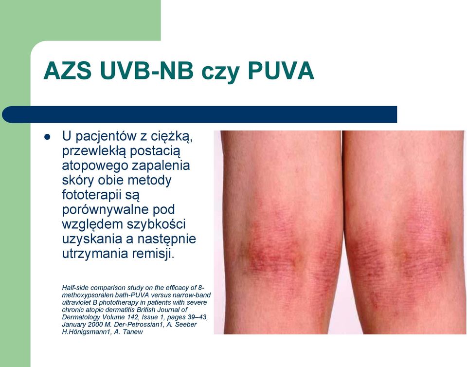 Half-side comparison study on the efficacy of 8- methoxypsoralen bath-puva versus narrow-band ultraviolet B phototherapy in