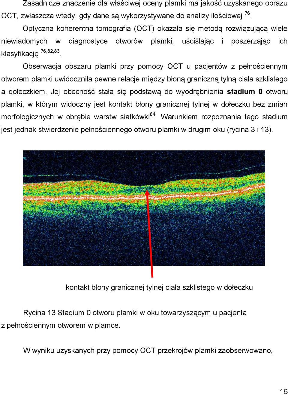 Obserwacja obszaru plamki przy pomocy OCT u pacjentów z pełnościennym otworem plamki uwidoczniła pewne relacje między błoną graniczną tylną ciała szklistego a dołeczkiem.