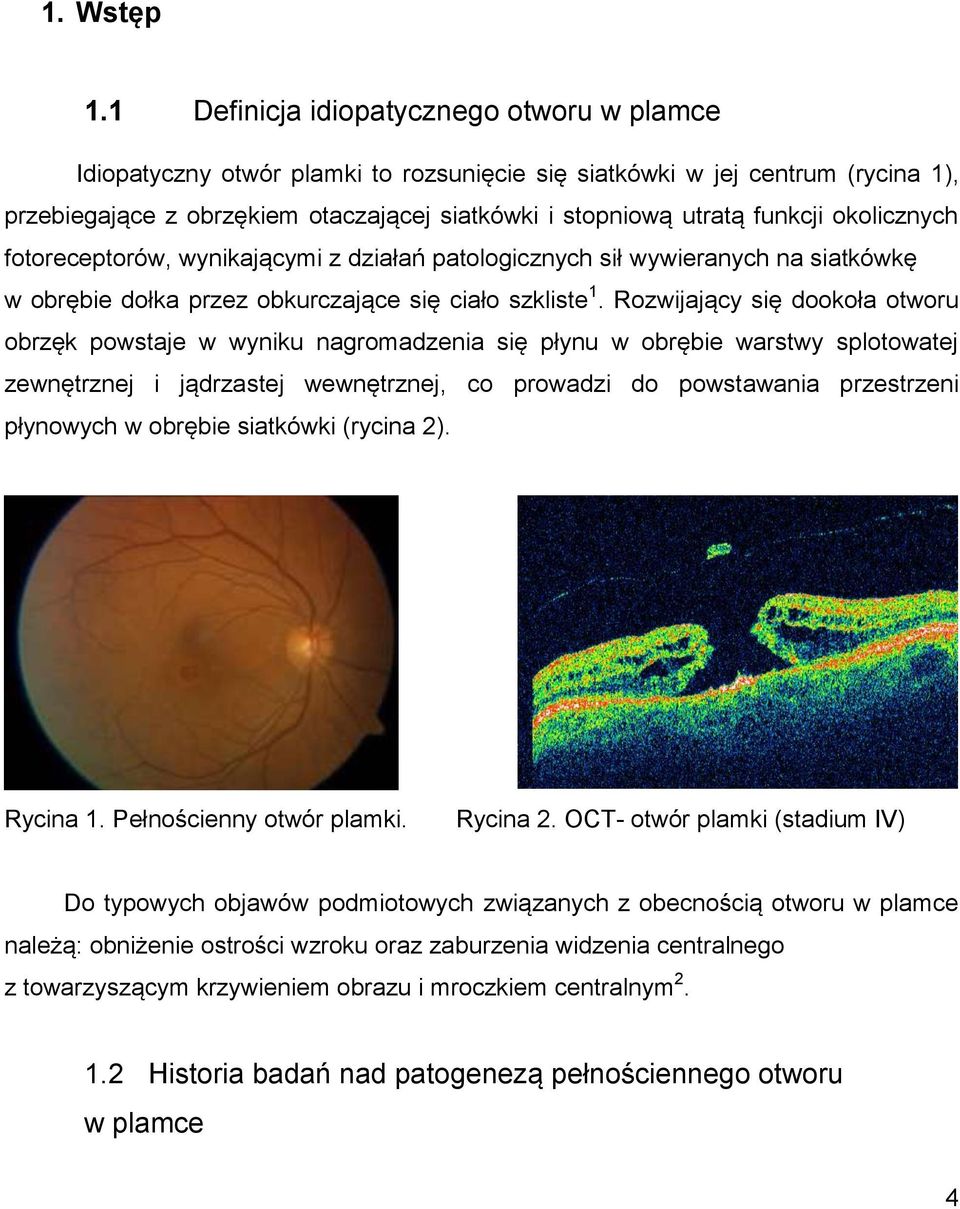 okolicznych fotoreceptorów, wynikającymi z działań patologicznych sił wywieranych na siatkówkę w obrębie dołka przez obkurczające się ciało szkliste 1.