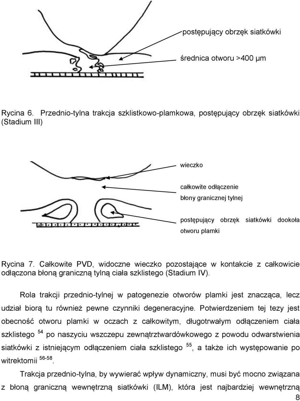 7. Całkowite PVD, widoczne wieczko pozostające w kontakcie z całkowicie odłączona błoną graniczną tylną ciała szklistego (Stadium IV).