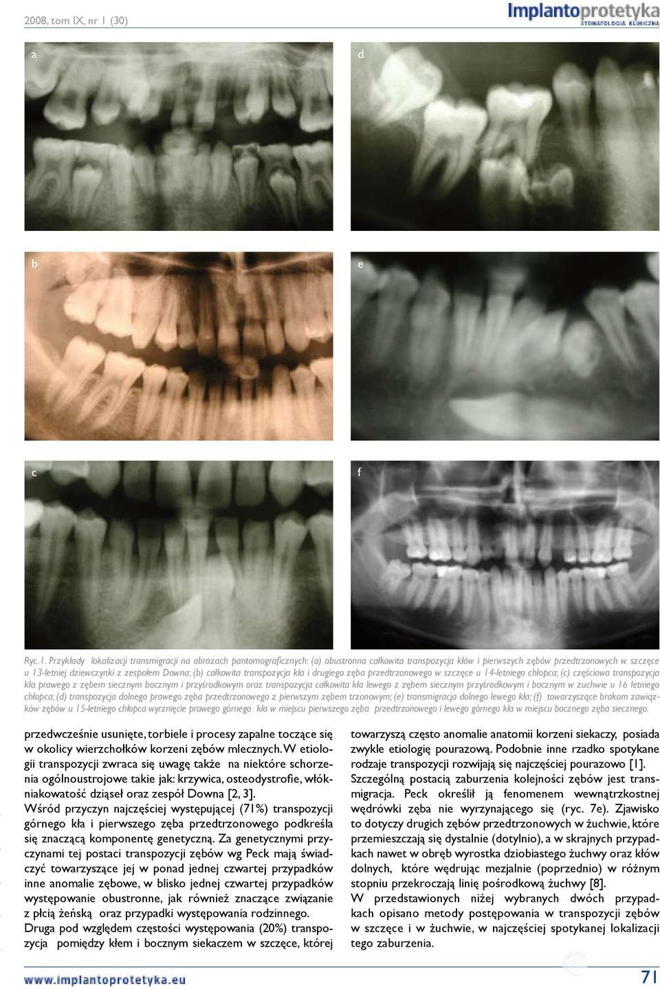 (b) całkowita transpozycja kła i drugiego zęba przedtrzonowego w szczęce u 14-letniego chłopca; (c) częściowa transpozycja kła prawego z zębem siecznym bocznym i przyśrodkowym oraz transpozycja