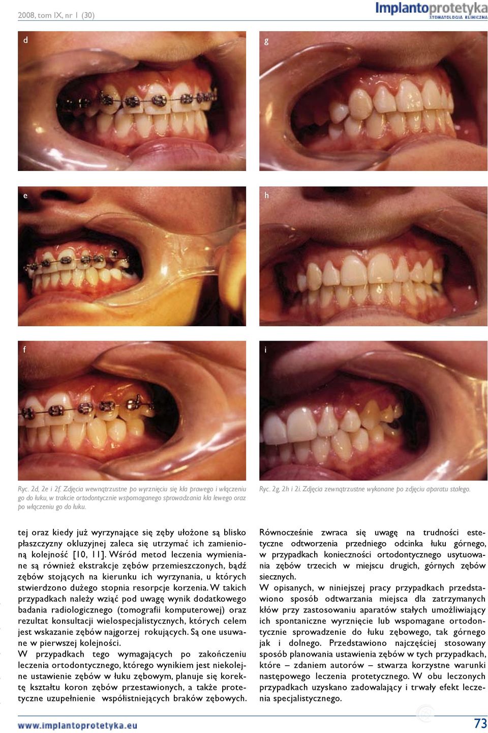 tej oraz kiedy już wyrzynające się zęby ułożone są blisko płaszczyzny okluzyjnej zaleca się utrzymać ich zamienioną kolejność [10, 11].
