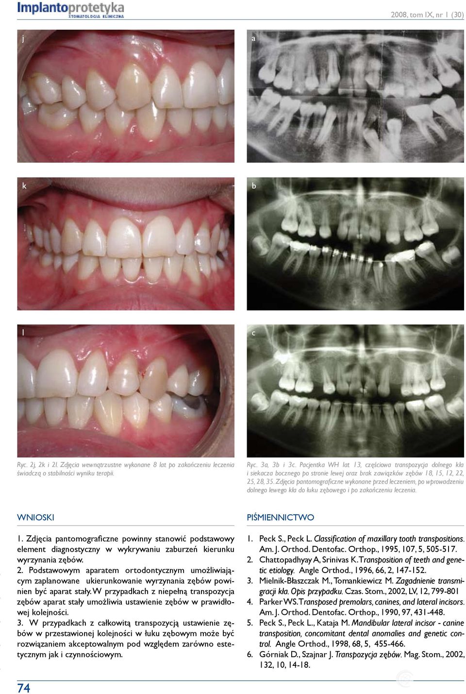Zdjęcia pantomograficzne wykonane przed leczeniem, po wprowadzeniu dolnego lewego kła do łuku zębowego i po zakończeniu leczenia. Wnioski 1.