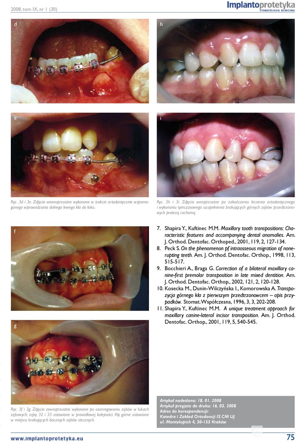 M. Maxillary tooth transpositions: Characteristic features and accompanying dental anomalies. Am. J. Orthod. Dentofac. Orthoped., 2001, 119, 2, 127-134. 8. Peck S.