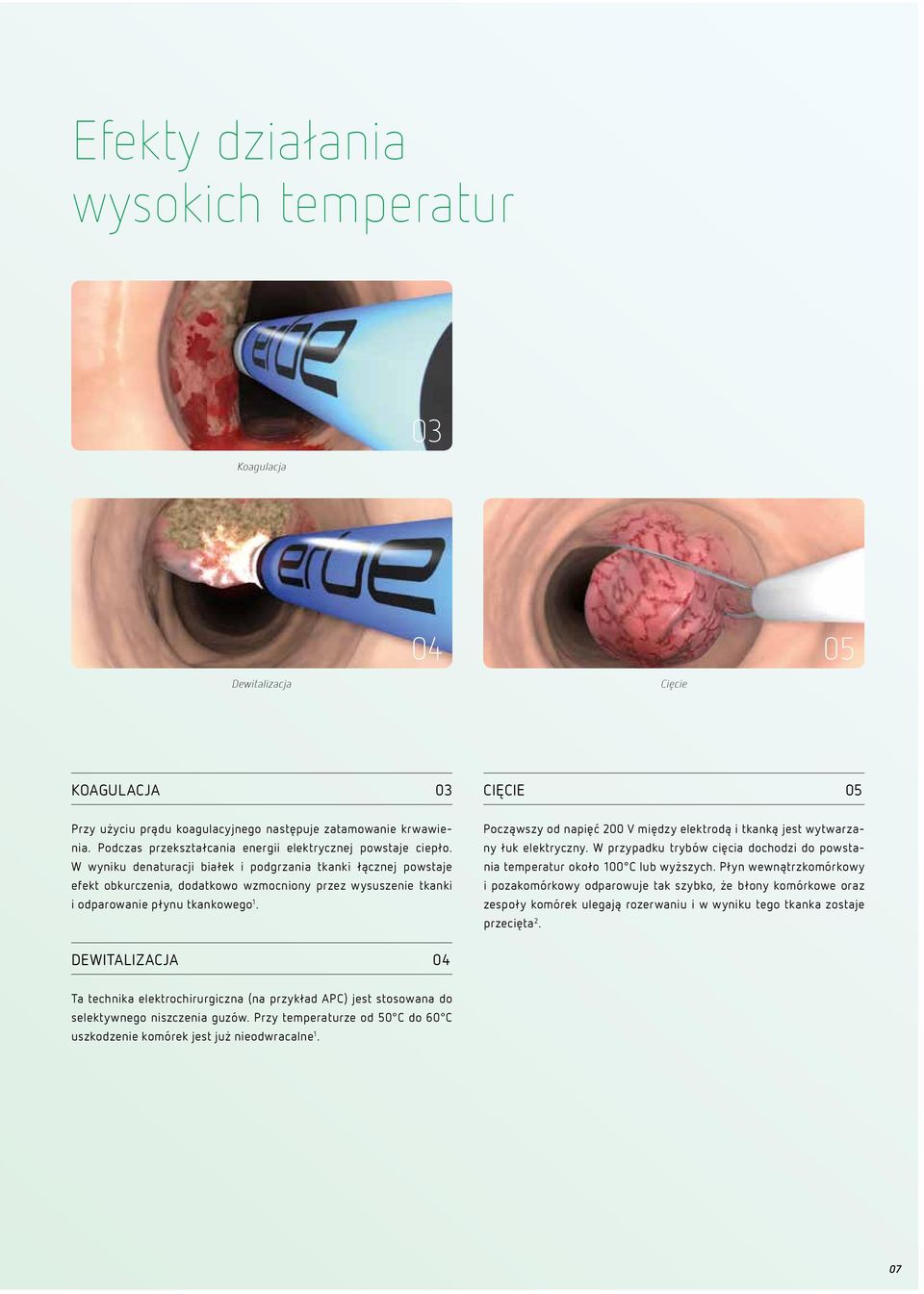 W wyniku denaturacji białek i podgrzania tkanki łącznej powstaje efekt obkurczenia, dodatkowo wzmocniony przez wysuszenie tkanki i odparowanie płynu tkankowego 1.