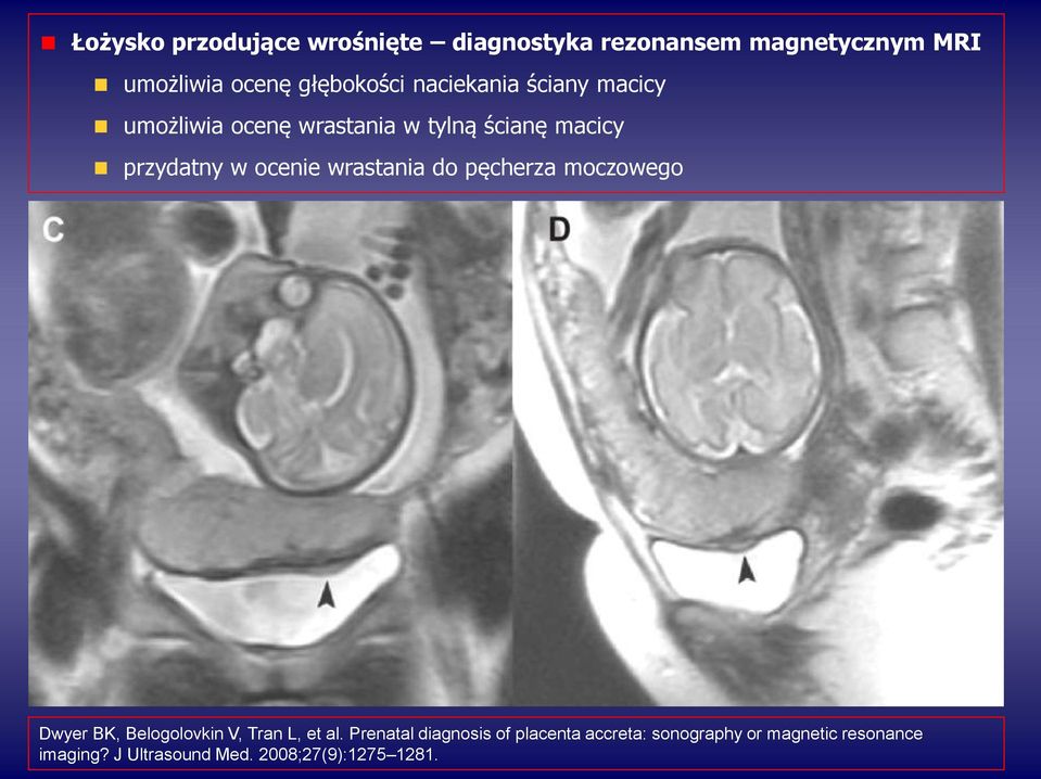 Łożysko wrośnięte przypadki kliniczne w diagnostyce ultrasonograficznej -  PDF Darmowe pobieranie