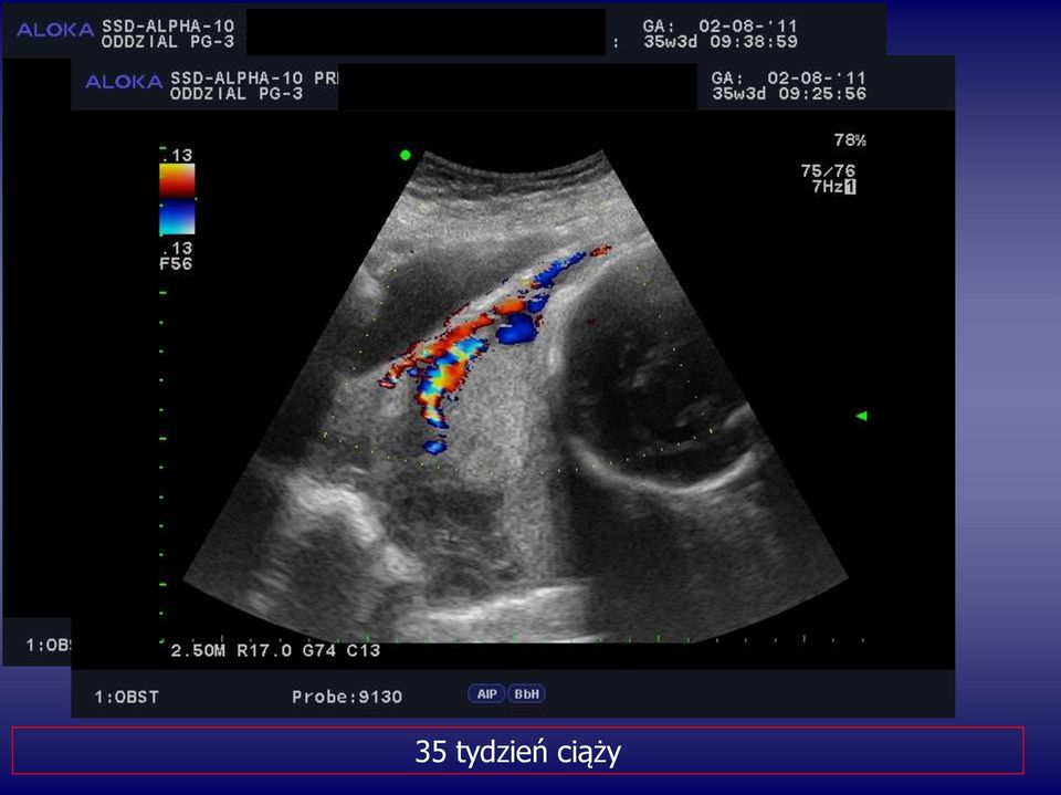 Łożysko wrośnięte przypadki kliniczne w diagnostyce ultrasonograficznej -  PDF Darmowe pobieranie