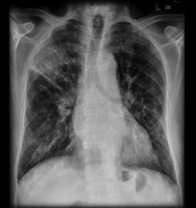 Amiodaron działania uboczne Efekt proarytmiczny - zwłaszcza z innymi lekami wydłużającymi odstęp QT Hipotonia Bradykardia Działania uboczne przewlekle stosowanego amiodaronu