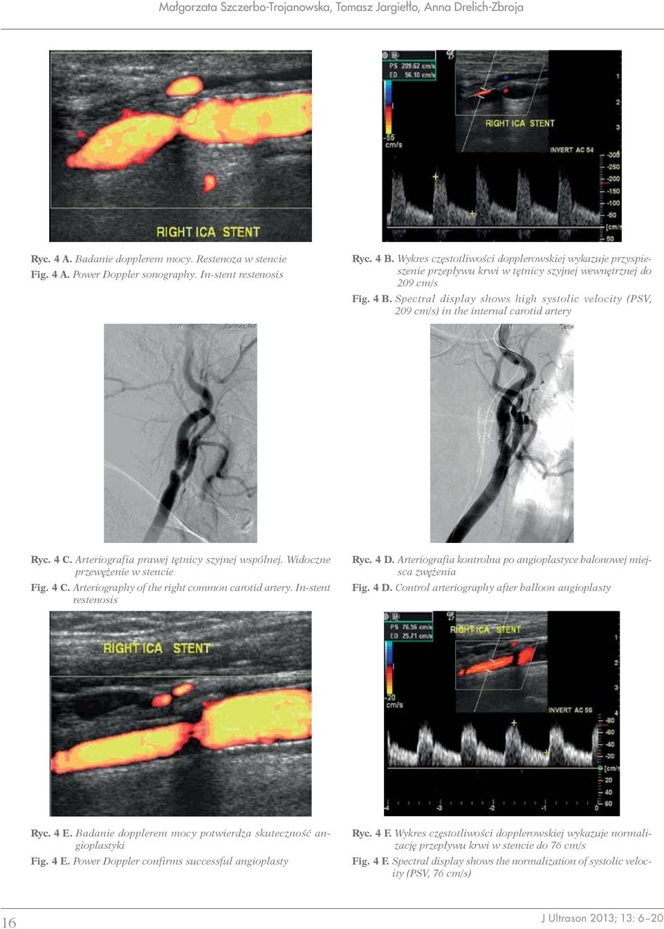 Spectral display shows high systolic velocity (PSV, 209 cm/s) in the internal carotid artery Ryc. 4 C. Arteriografia prawej tętnicy szyjnej wspólnej. Widoczne przewężenie w stencie Fig. 4 C. Arteriography of the right common carotid artery.