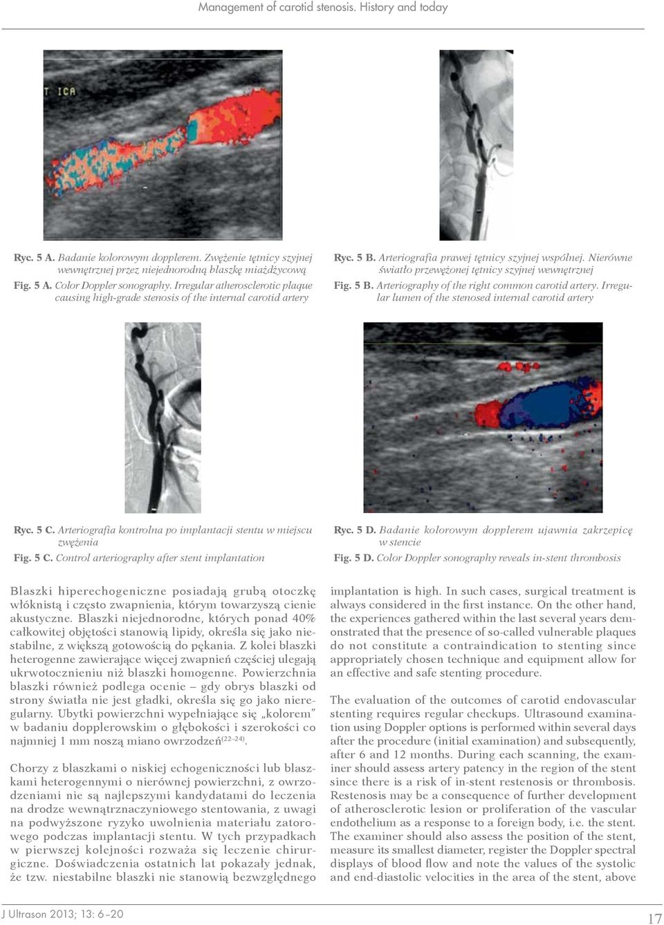 Nierówne światło przewężonej tętnicy szyjnej wewnętrznej Fig. 5 B. Arteriography of the right common carotid artery. Irregular lumen of the stenosed internal carotid artery Ryc. 5 C.