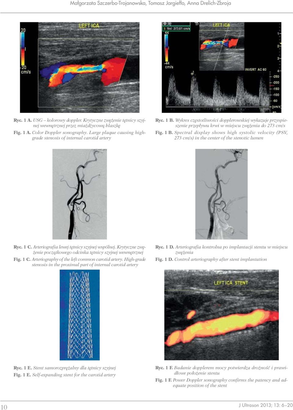 1 C. Arteriografia lewej tętnicy szyjnej wspólnej. Krytyczne zwężenie początkowego odcinka tętnicy szyjnej wewnętrznej Fig. 1 C. Arteriography of the left common carotid artery.