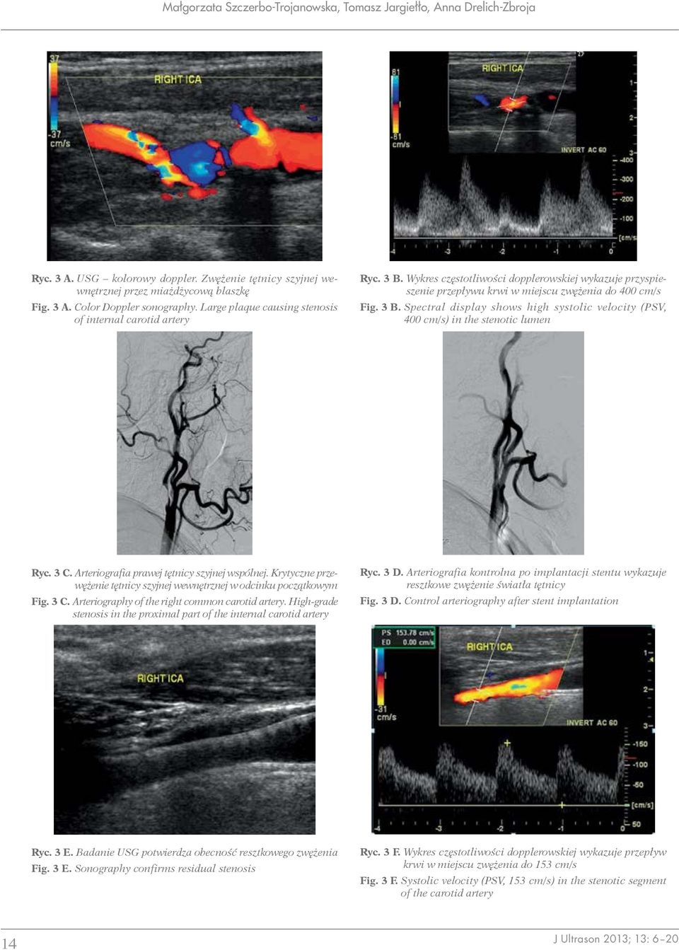 3 C. Arteriografia prawej tętnicy szyjnej wspólnej. Krytyczne przewężenie tętnicy szyjnej wewnętrznej w odcinku początkowym Fig. 3 C. Arteriography of the right common carotid artery.