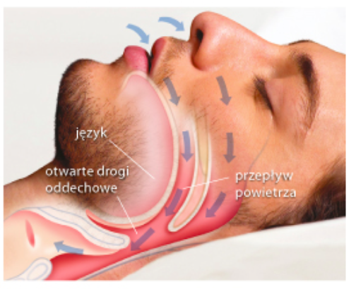 lekarze rozróżniają trzy rodzaje bezdechu: obturacyjny (ang. Obstructive Sleep Apnea, OSA), centralny (ang. Central Sleep Apnea, CSA) i mieszany [2].