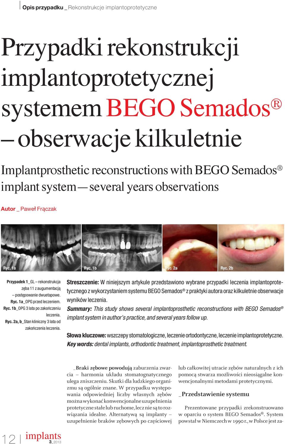 2a, b_stan kliniczny 3 lata od zakoƒczenia Streszczenie: W niniejszym artykule przedstawiono wybrane przypadki leczenia implantoprotetycznego z wykorzystaniem systemu BEGO Semados z praktyki autora