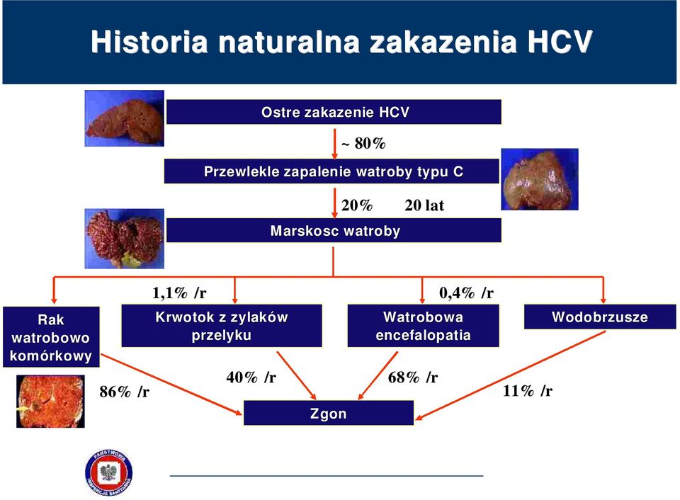 watroby Rak watrobowo komórkowy 86% /r 1,1% /r 0,4% /r Krwotok z