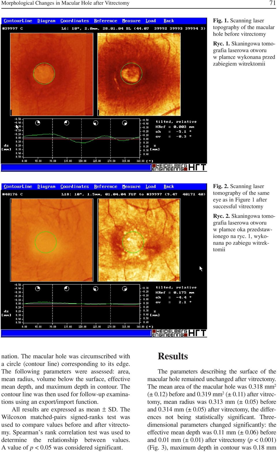 1, wyko nana witrek tomii nation. The macular hole was circumscribed with a circle (contour line) corresponding to its edge.
