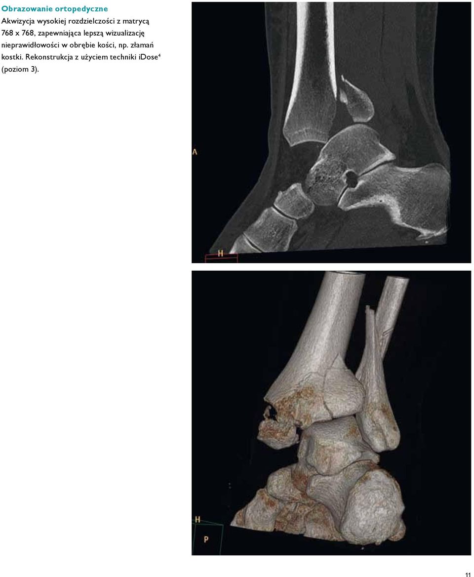 wizualizację nieprawidłowości w obrębie kości, np.