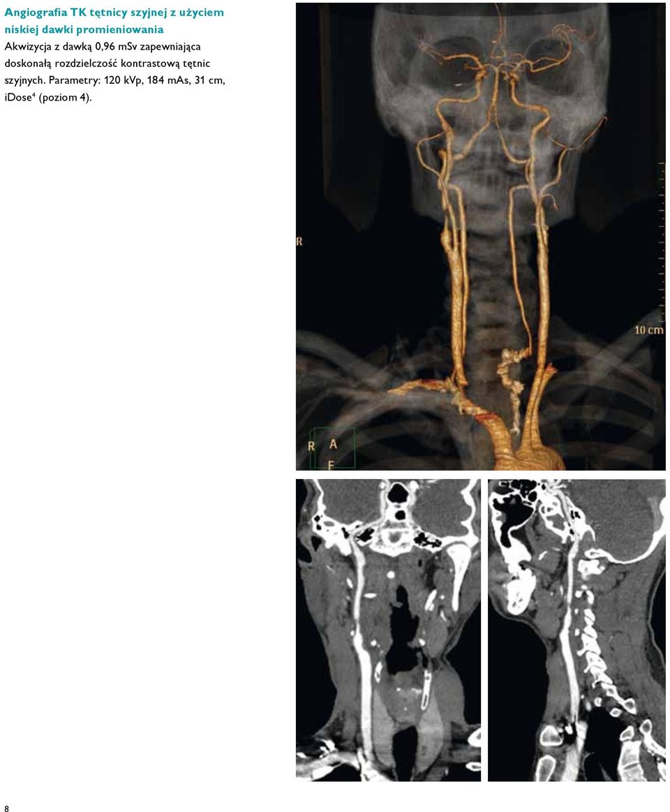 doskonałą rozdzielczość kontrastową tętnic szyjnych.