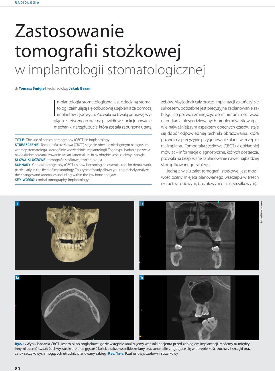 Pozwala na trwałą poprawę wyglądu estetycznego oraz na prawidłowe funkcjonowanie mechaniki narządu żucia, która została zaburzona utratą TITLE: The use of conical tomography (CBCT) in implantology