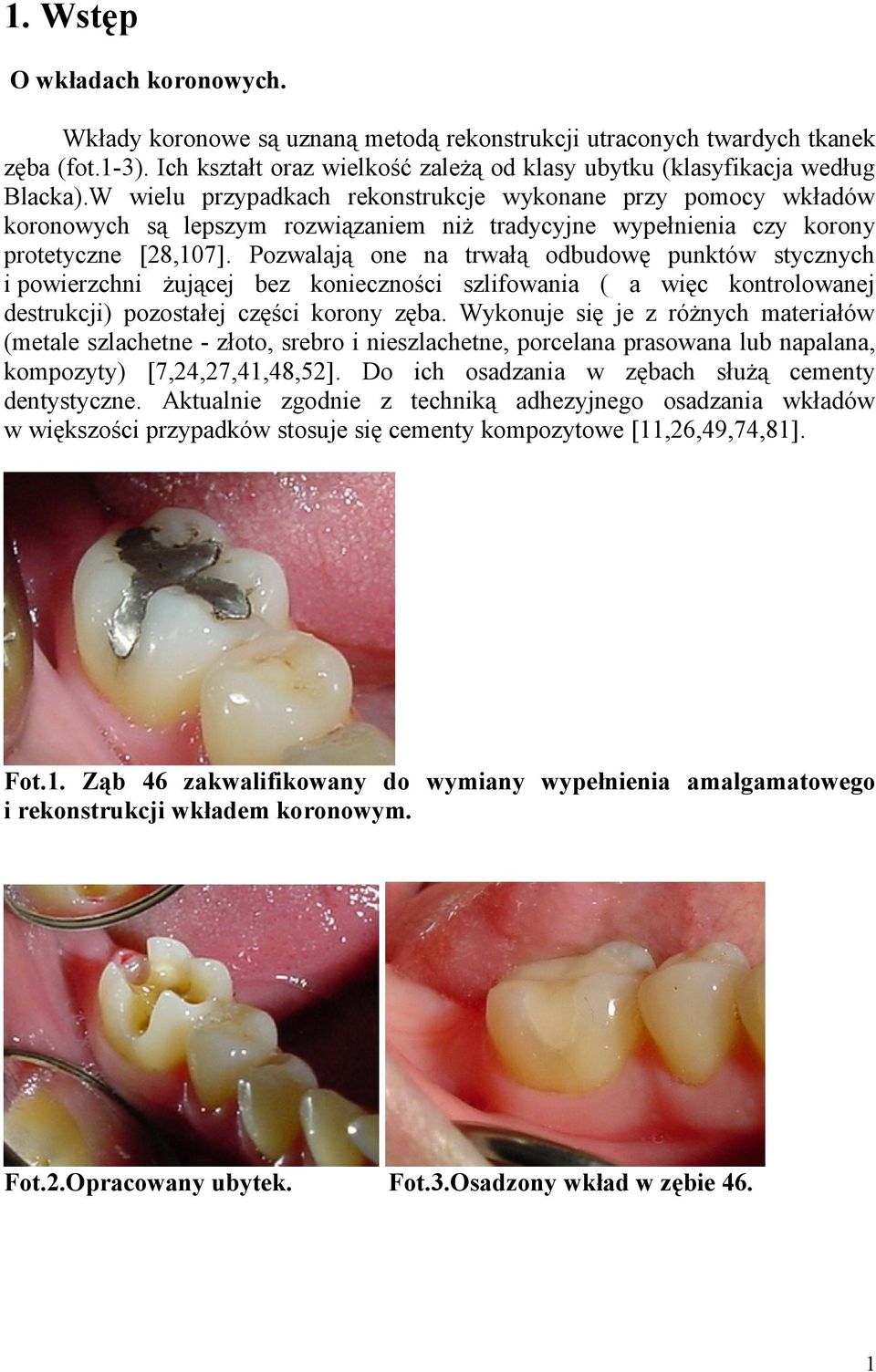 Pozwalają one na trwałą odbudowę punktów stycznych i powierzchni żującej bez konieczności szlifowania ( a więc kontrolowanej destrukcji) pozostałej części korony zęba.