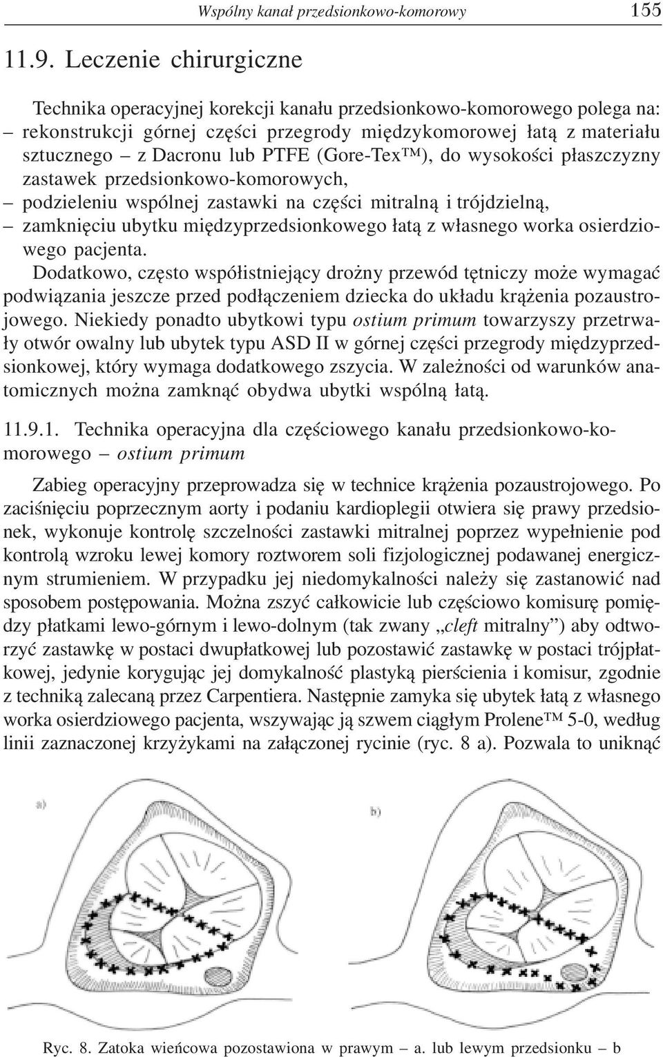(Gore-Tex ), do wysokoœci p³aszczyzny zastawek przedsionkowo-komorowych, podzieleniu wspólnej zastawki na czêœci mitraln¹ i trójdzieln¹, zamkniêciu ubytku miêdzyprzedsionkowego ³at¹ z w³asnego worka