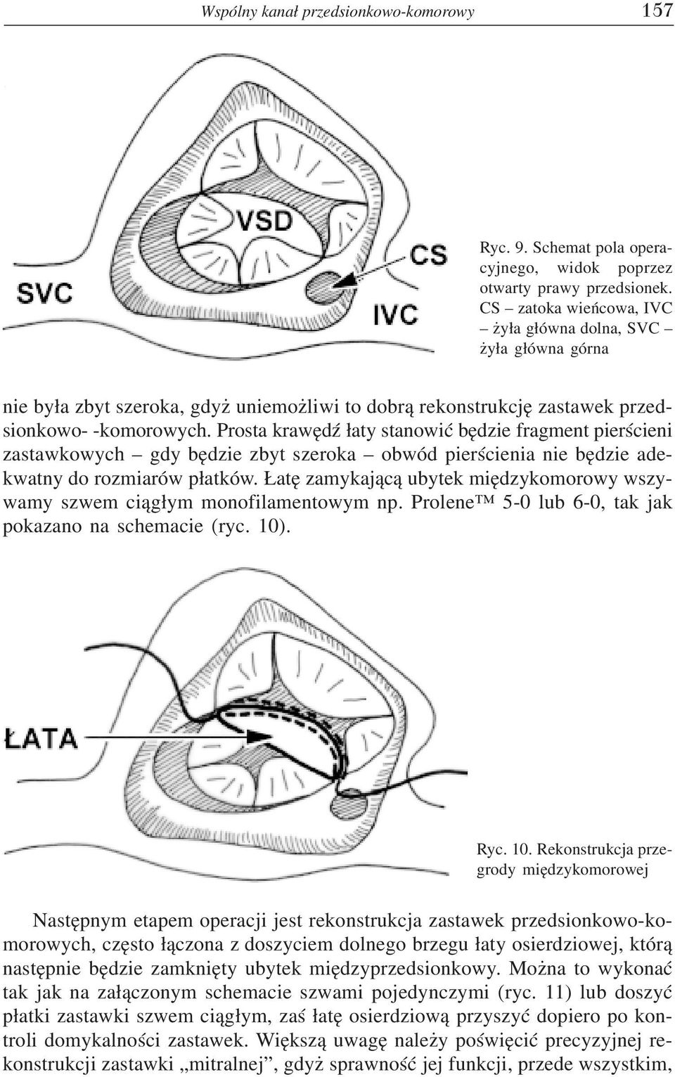 Prosta krawêdÿ ³aty stanowiæ bêdzie fragment pierœcieni zastawkowych gdy bêdzie zbyt szeroka obwód pierœcienia nie bêdzie adekwatny do rozmiarów p³atków.