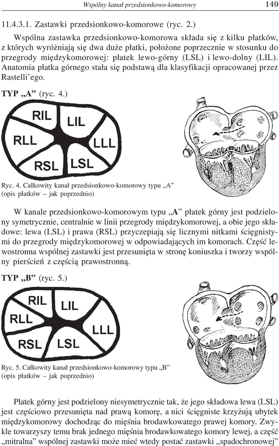lewo-dolny (LIL). Anatomia p³atka górnego sta³a siê podstaw¹ dla klasyfikacji opracowanej przez Rastelli ego. TYP A (ryc. 4.