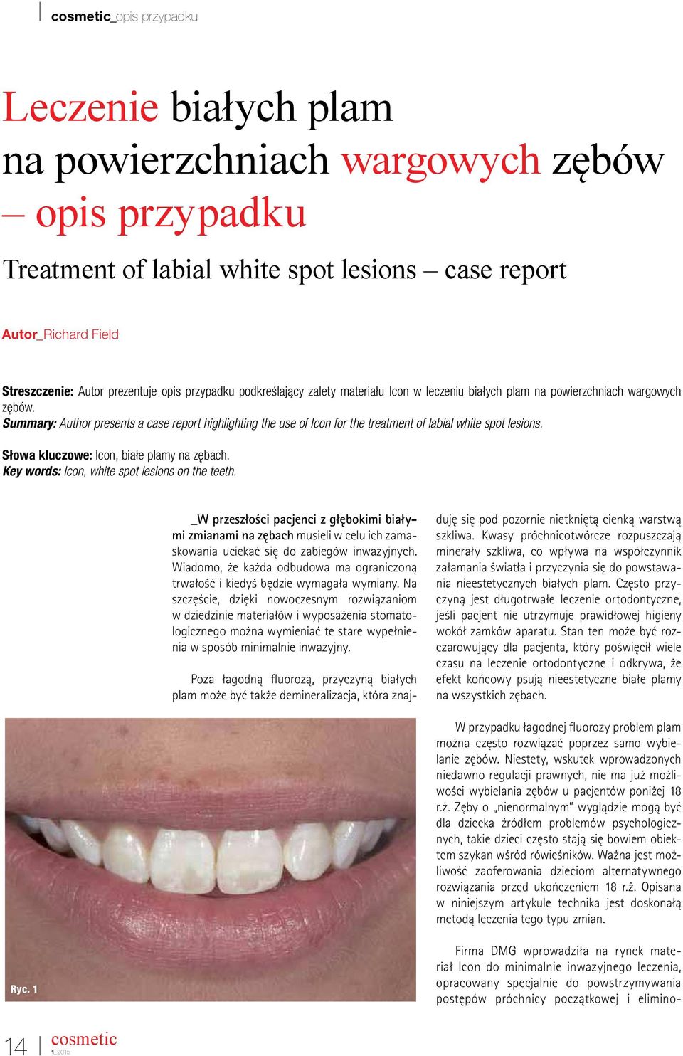 Summary: Author presents a case report highlighting the use of Icon for the treatment of labial white spot lesions. Słowa kluczowe: Icon, białe plamy na zębach.