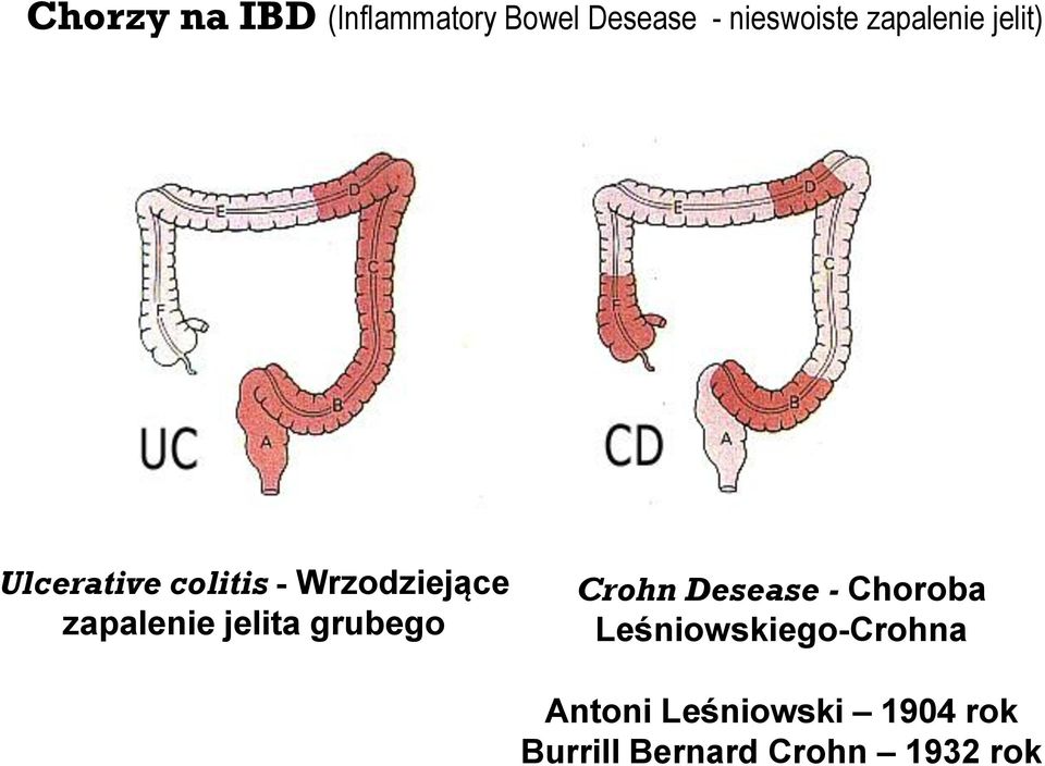 zapalenie jelita grubego Crohn Desease - Choroba