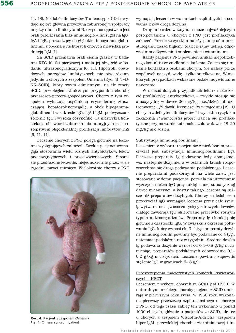 IgA i IgE, prowadzący do głębokiej hipogammaglobulinemii, z obecną u niektórych chorych niewielką produkcją IgM [1].