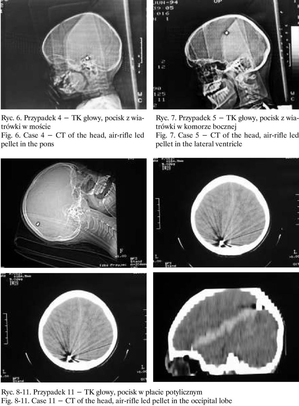 Case 5 CT of the head, air-rifle led in the lateral ventricle Ryc. 8-11.