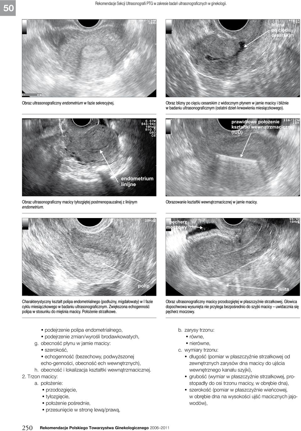 Obraz ultrasonograficzny macicy tyłozgiętej postmenopauzalnej z linijnym endometrium. Obrazowanie kształtki wewnątrzmacicznej w jamie macicy.