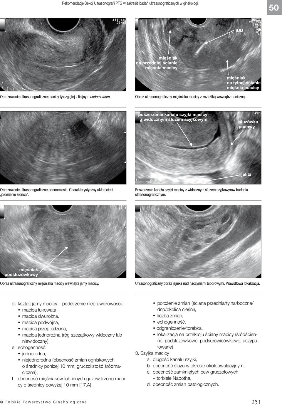 Poszerzenie kanału szyjki macicy z widocznym śluzem szyjkowymw badaniu ultrasonograficznym. Obraz ultrasonograficzny mięśniaka macicy wewnątrz jamy macicy.