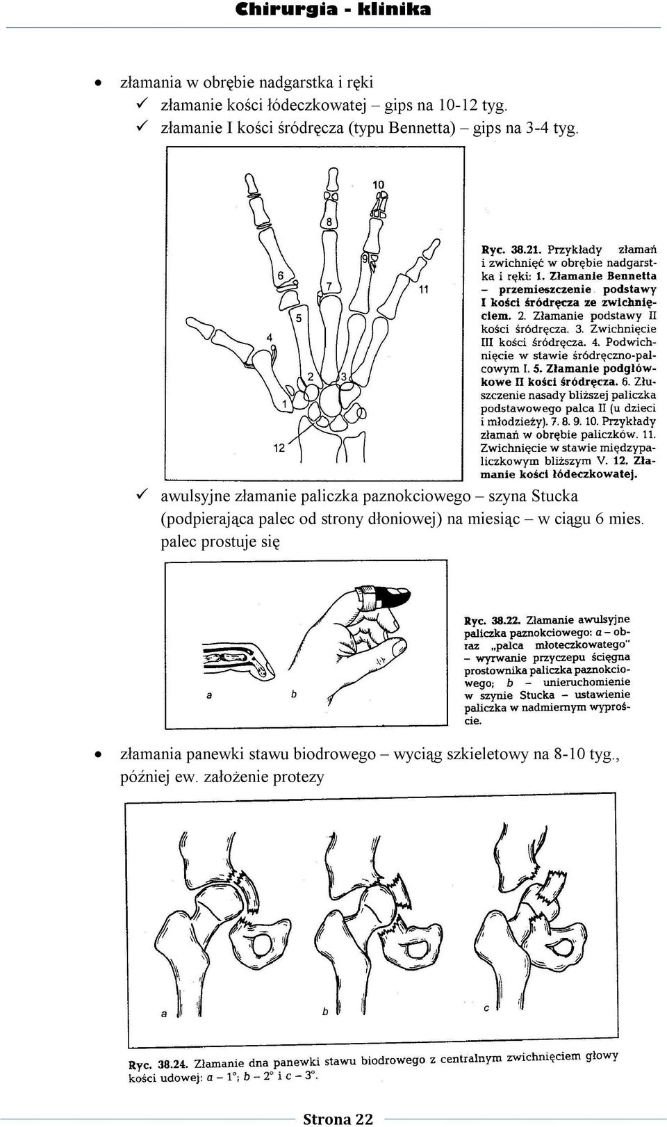 awulsyjne złamanie paliczka paznokciowego szyna Stucka (podpierająca palec od strony dłoniowej) na