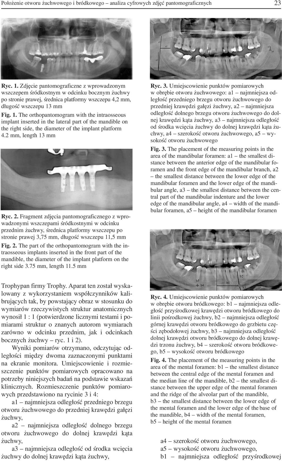 mm Fig. 1. The orthopantomogram with the intraosseous implant inserted in the lateral part of the mandible on the right side, the diameter of the implant platform 4.2 mm, length 13 mm Ryc. 2.