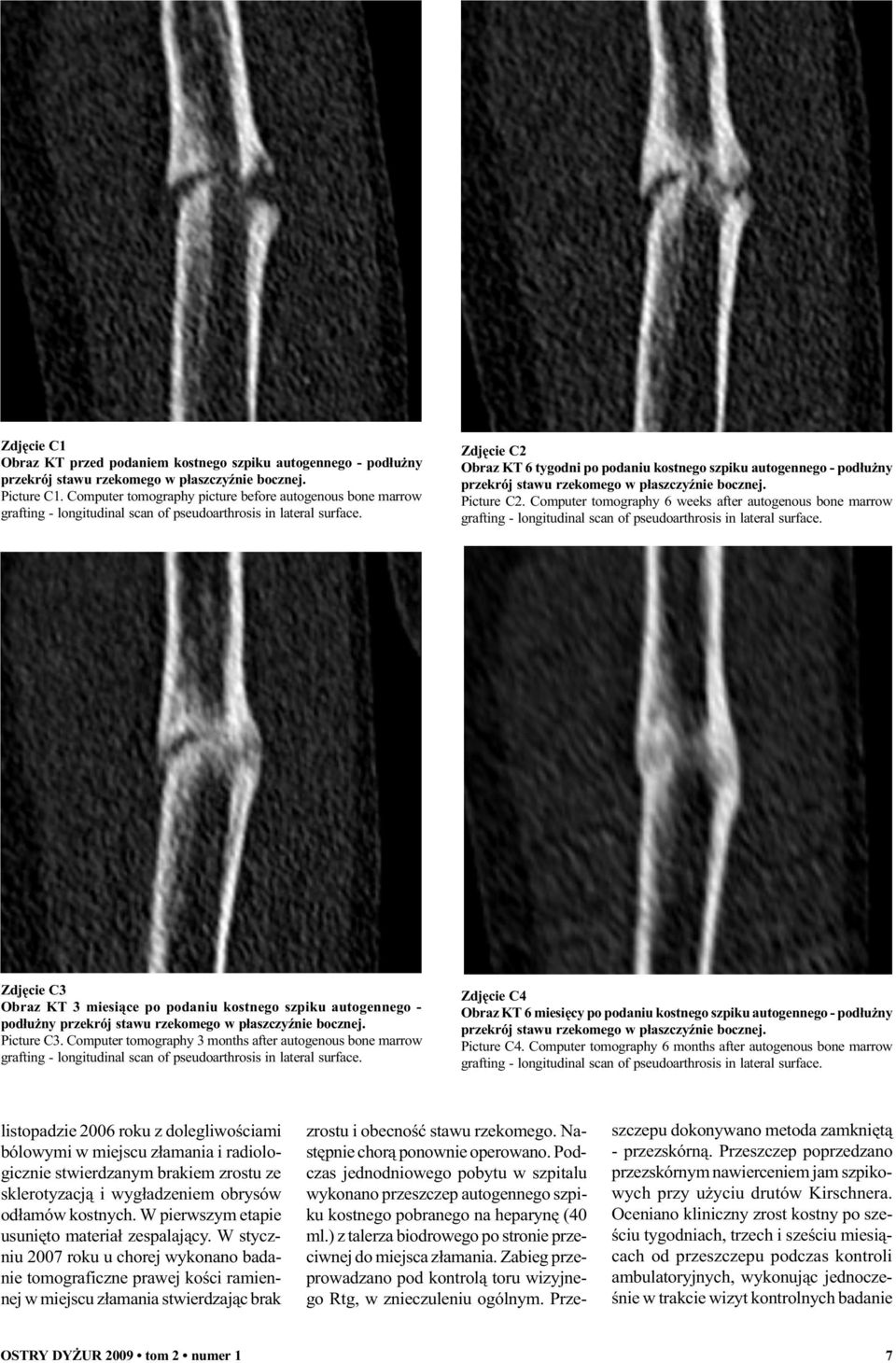 Computer tomography 6 weeks after autogenous bone marrow Zdjêcie C3 Obraz KT 3 miesi¹ce po podaniu kostnego szpiku autogennego - pod³u ny przekrój stawu rzekomego w p³aszczyÿnie bocznej. Picture C3.
