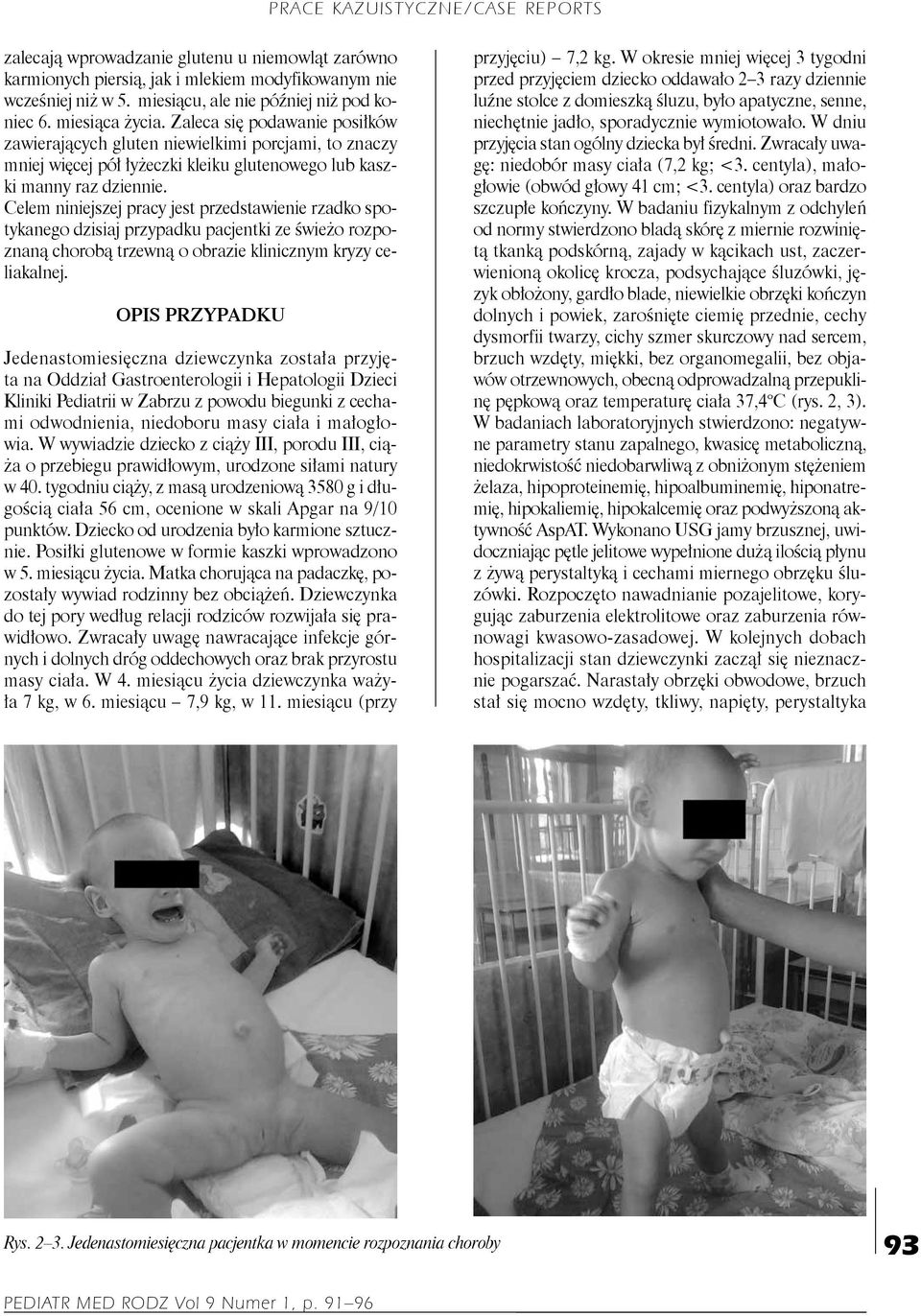 Celem niniejszej pracy jest przedstawienie rzadko spotykanego dzisiaj przypadku pacjentki ze świeżo rozpoznaną chorobą trzewną o obrazie klinicznym kryzy celiakalnej.