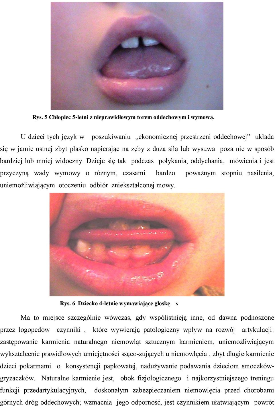 Dzieje się tak podczas połykania, oddychania, mówienia i jest przyczyną wady wymowy o różnym, czasami bardzo poważnym stopniu nasilenia, uniemożliwiającym otoczeniu odbiór zniekształconej mowy. Rys.