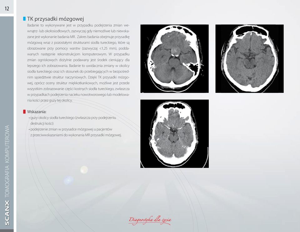 komputerowym. W przypadku zmian ogniskowych dożylnie podawany jest środek cieniujący dla lepszego ich zobrazowania.