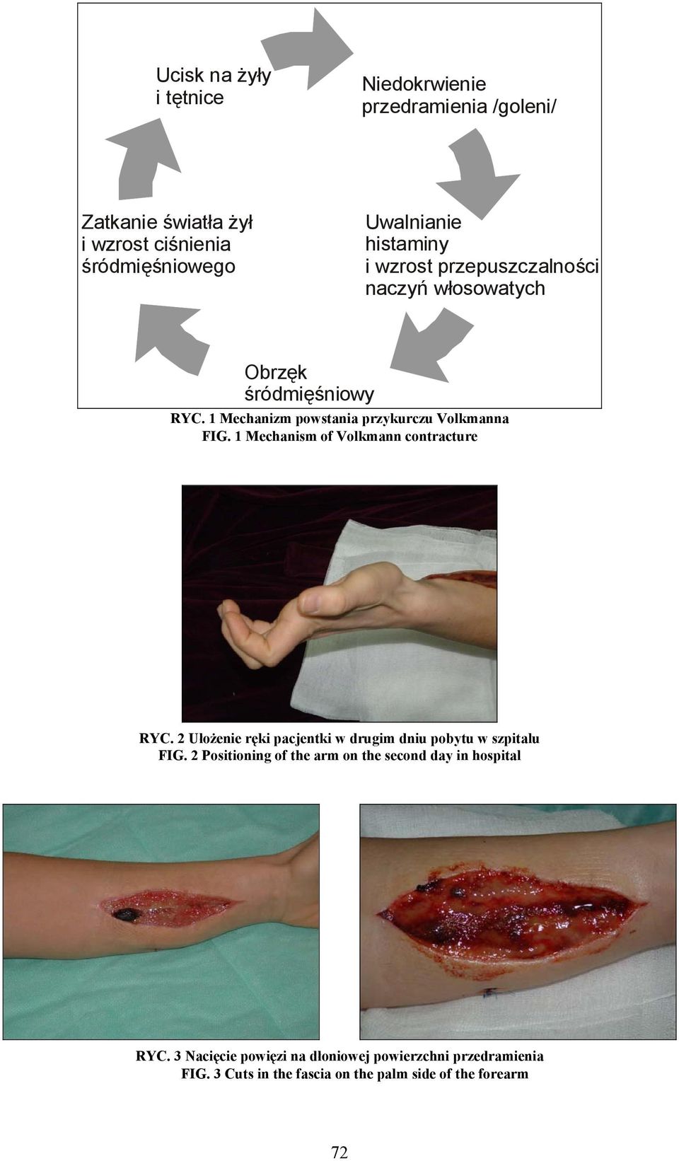 1 Mechanism of Volkmann contracture RYC. 2 Ułożenie ręki pacjentki w drugim dniu pobytu w szpitalu FIG.
