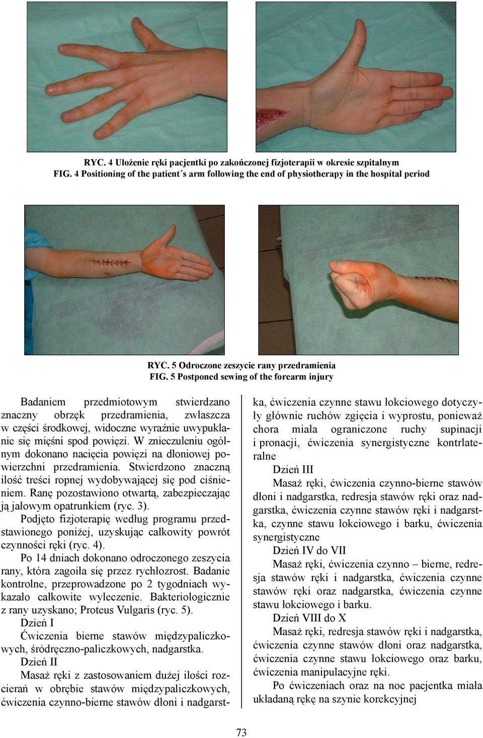 5 Postponed sewing of the forearm injury Badaniem przedmiotowym stwierdzano znaczny obrzęk przedramienia, zwłaszcza w części środkowej, widoczne wyraźnie uwypuklanie się mięśni spod powięzi.