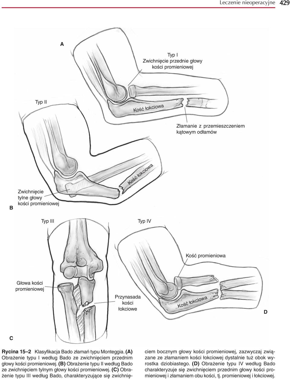 (A) Obrażenie typu I według Bado ze zwichnięciem przednim głowy kości promieniowej. (B) Obrażenie typu II według Bado ze zwichnięciem tylnym głowy kości promieniowej.