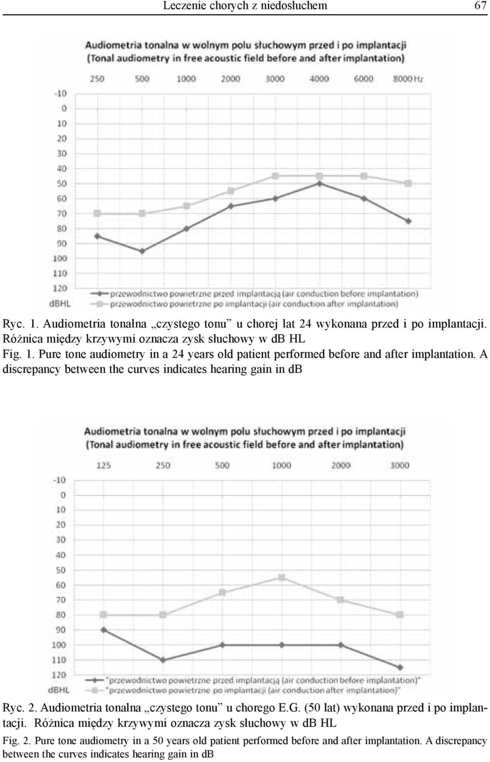 A discrepancy between the curves indicates hearing gain in db Ryc. 2. Audiometria tonalna czystego tonu u chorego E.G. (50 lat) wykonana przed i po implantacji.