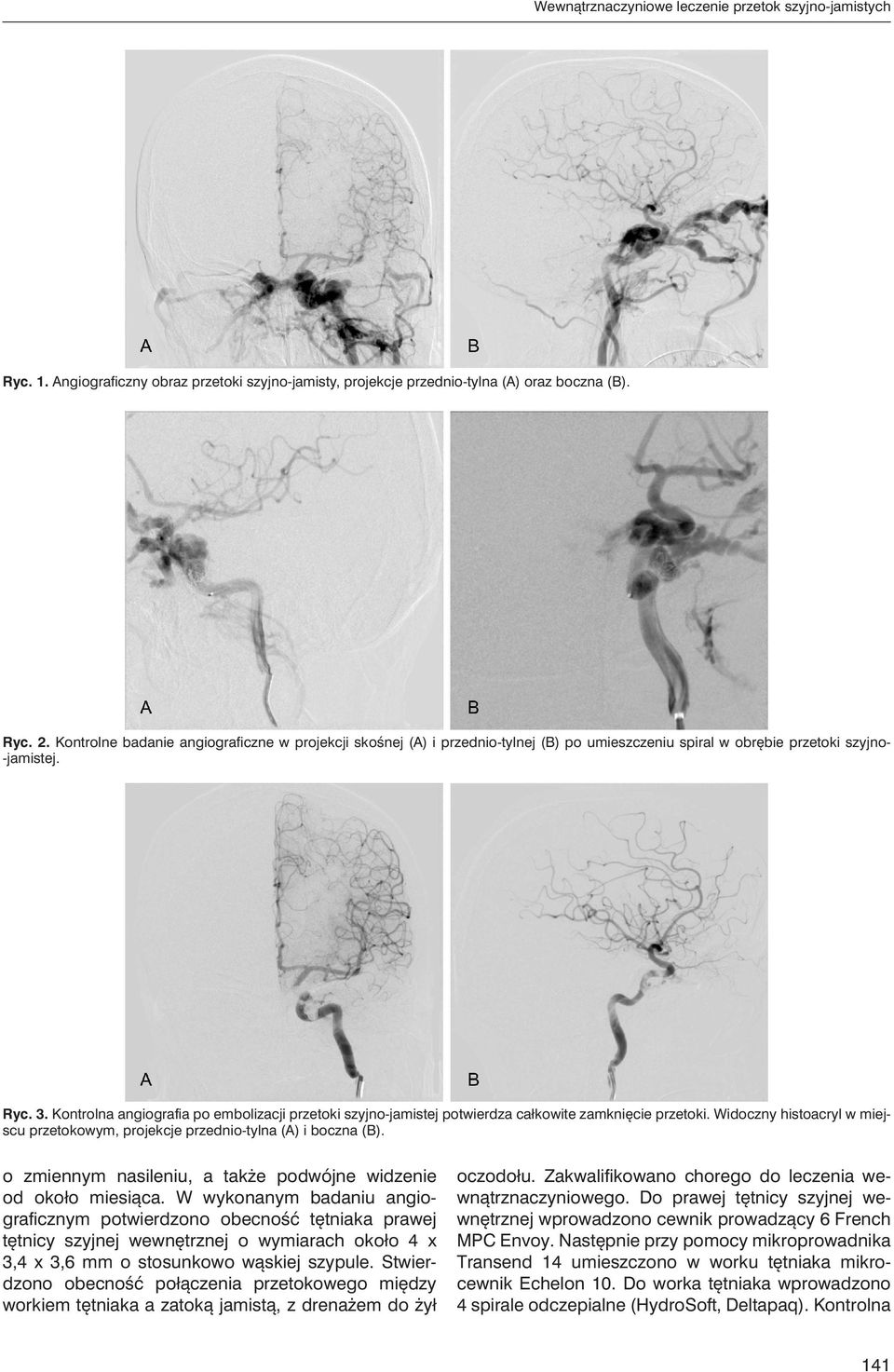 Kontrolna angiografia po embolizacji przetoki szyjno-jamistej potwierdza całkowite zamknięcie przetoki. Widoczny histoacryl w miejscu przetokowym, projekcje przednio-tylna (A) i boczna (B).