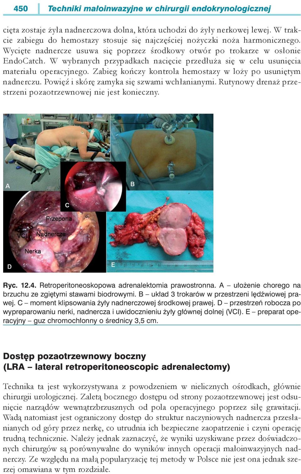 Zabieg kończy kontrola hemostazy w loży po usuniętym nadnerczu. Powięź i skórę zamyka się szwami wchłanianymi. Rutynowy drenaż przestrzeni pozaotrzewnowej nie jest konieczny. Ryc. 12.4.